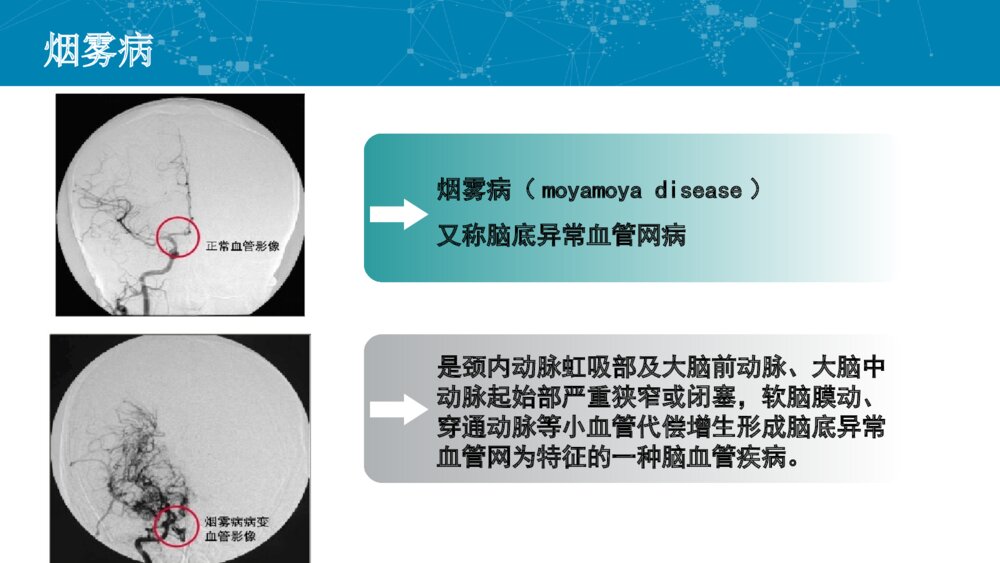 烟雾病的护理培训PPT课件4