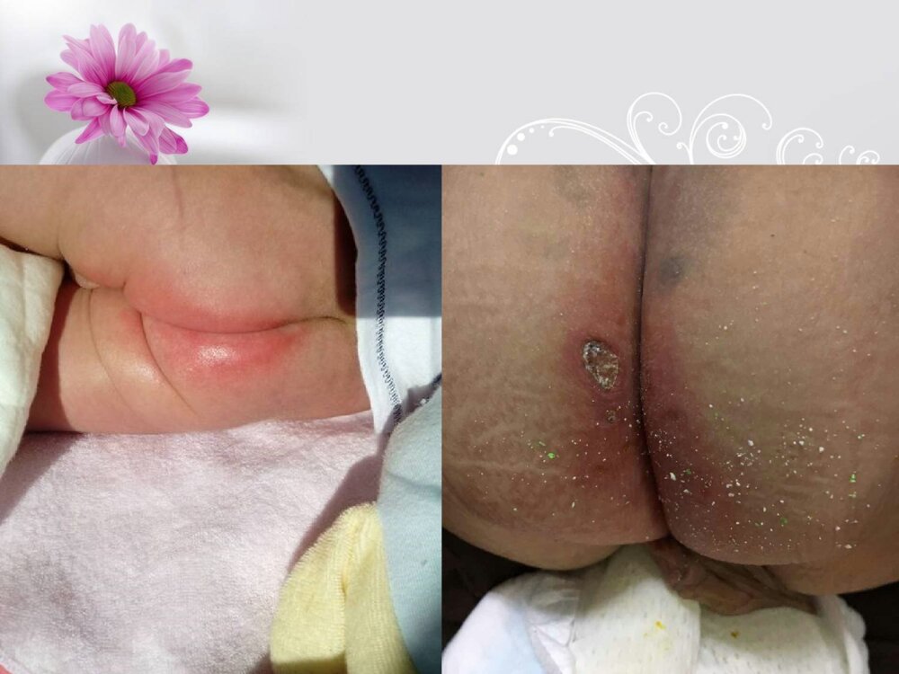 婴儿红臀的预防及护理ppt课件下载5