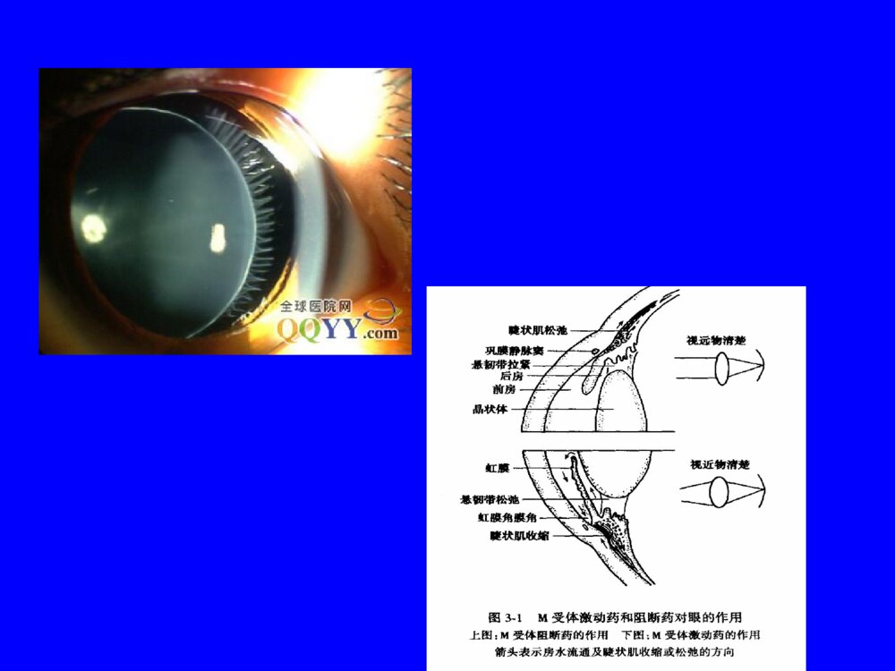 先天性晶状体半脱位患儿的护理查询ppt课件下载8