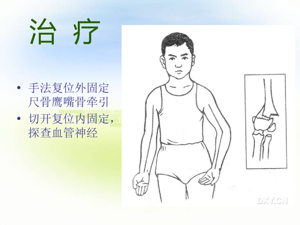 四肢骨折护理常规ppt课件下载7