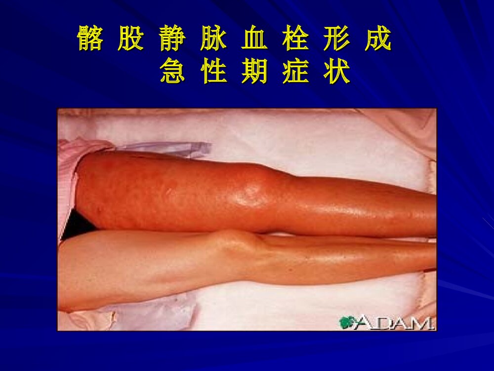 进修班血栓形成机制及抗栓药物作用靶点ppt课件下载10