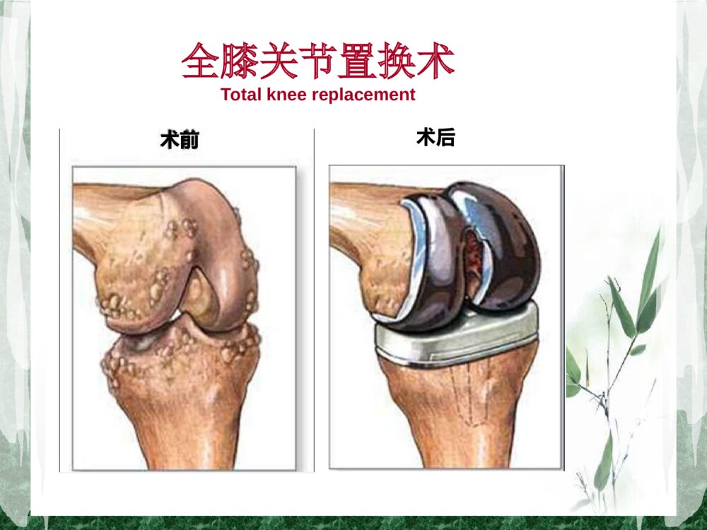 全膝关节置换术后护理查房ppt课件3
