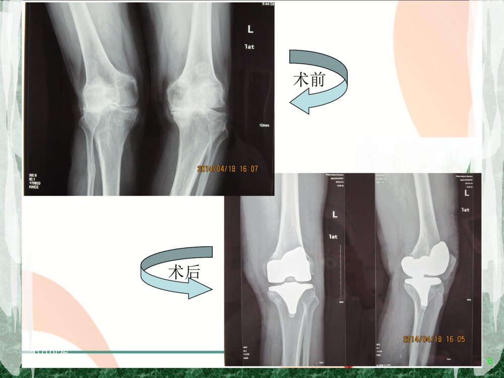 全膝关节置换术后护理查房ppt课件6