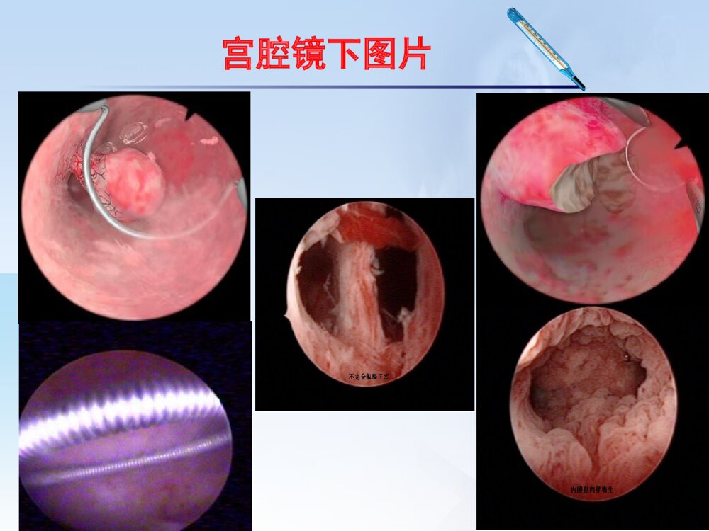 宫腔镜手术护理ppt课件下载4