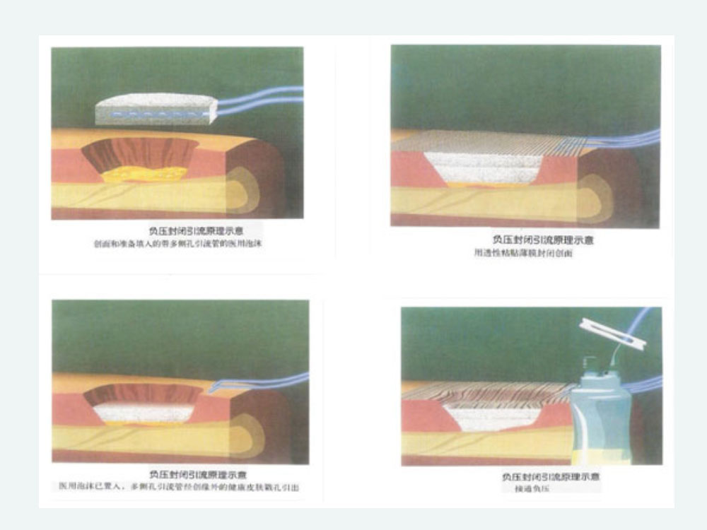 VSD负压吸引的应用及护理ppt课件下载4