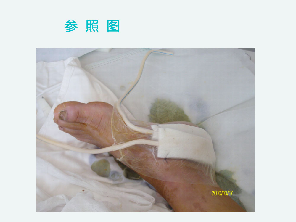 VSD负压吸引的应用及护理ppt课件下载8
