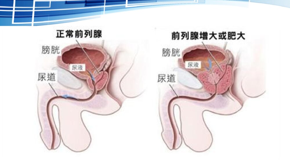 前列腺电切术后护理ppt课件下载3