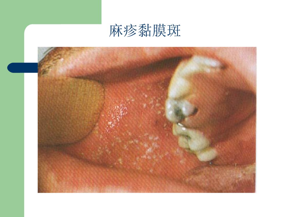 麻疹的护理优质ppt课件下载4