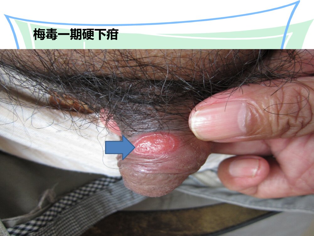 梅毒患者的护理ppt课件5