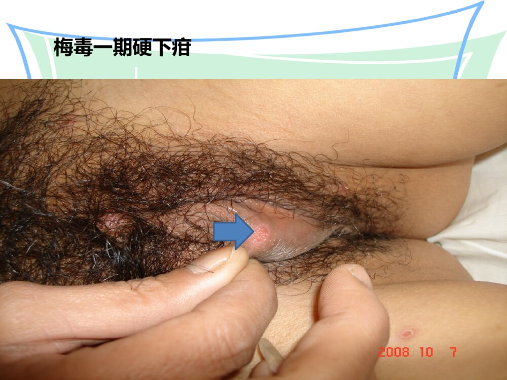 梅毒患者的护理ppt课件6