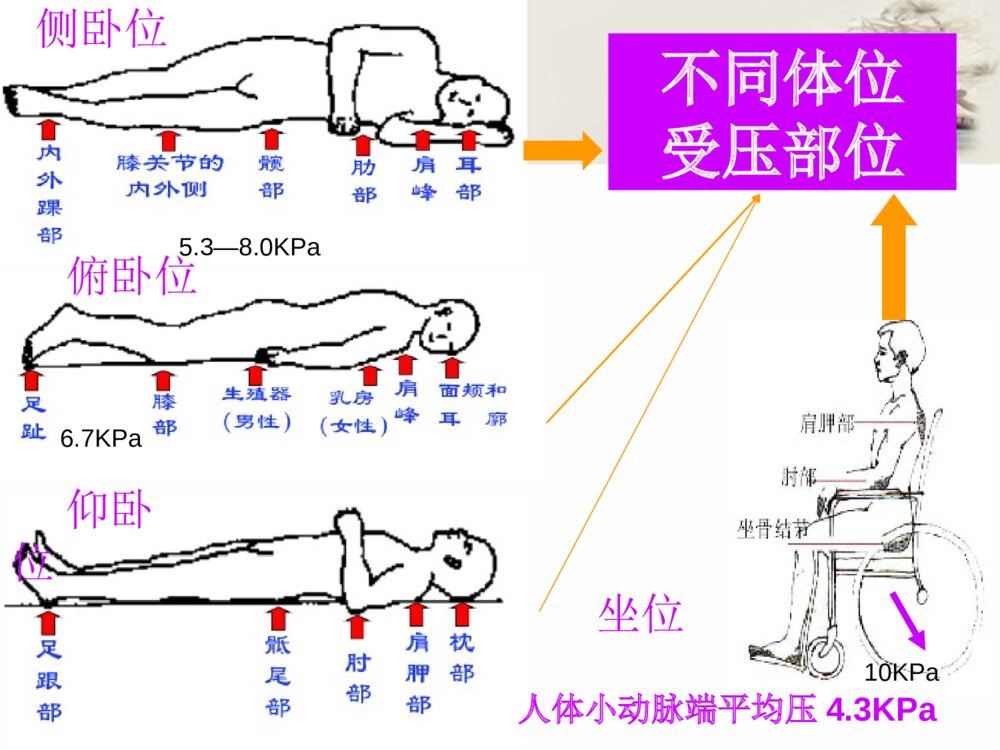 压疮预防及护理ppt课件下载6