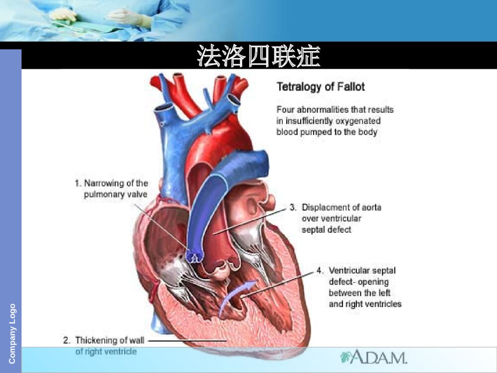 法洛四联症术前术后护理ppt课件下载3
