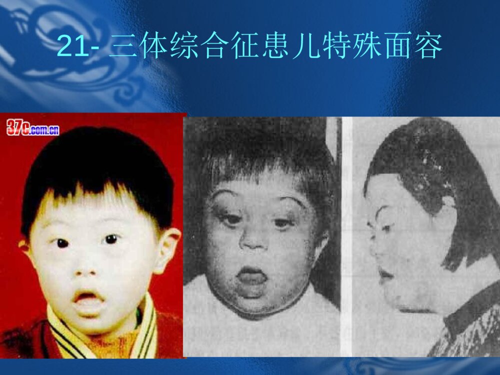 遗传性疾病21-三体综合征解析ppt课件下载5