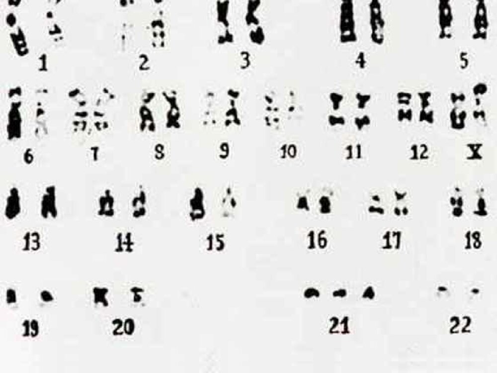 遗传性疾病21-三体综合征解析ppt课件下载9