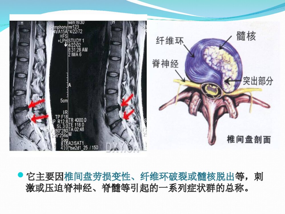 腰椎间盘突出症护理查房教学ppt课件下载7