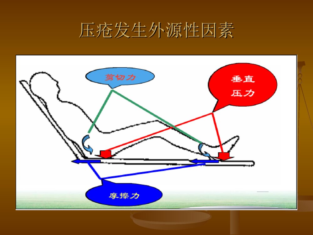 压疮的分期及护理PPT课件6