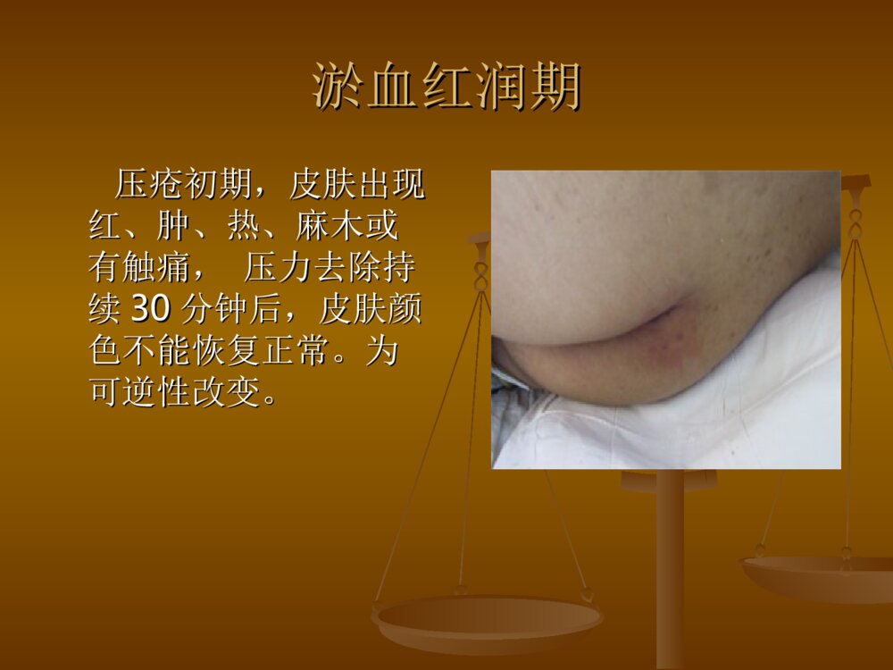 压疮的分期及护理PPT课件9