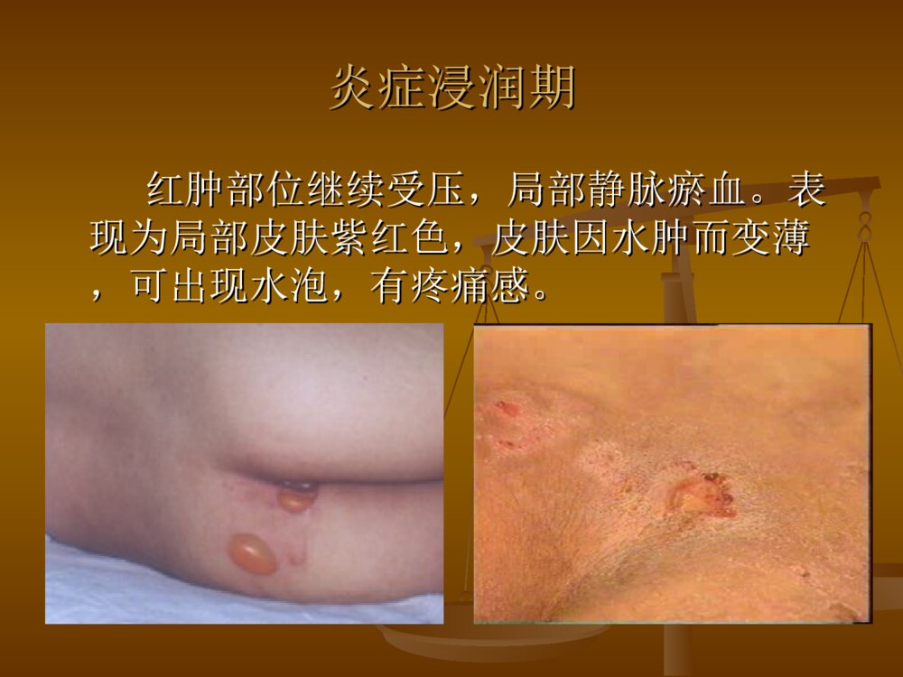 压疮的分期及护理PPT课件10