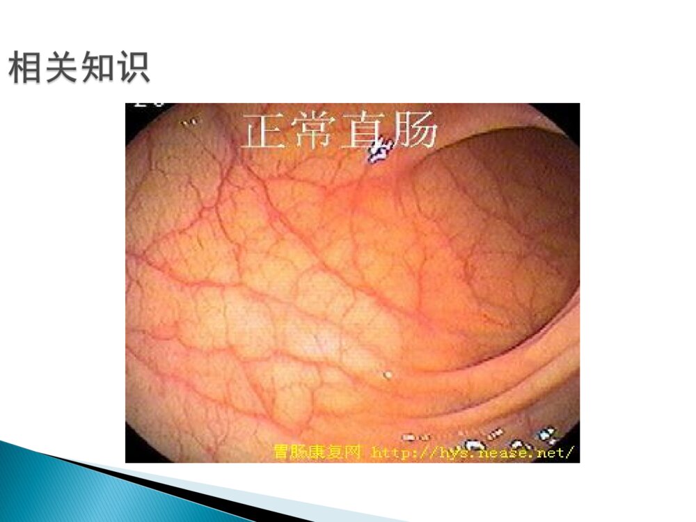 结肠息肉的护理ppt课件下载9