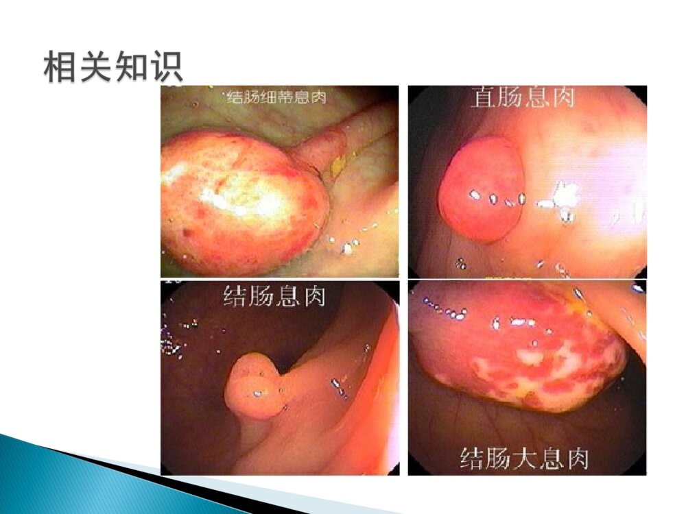 结肠息肉的护理ppt课件下载10