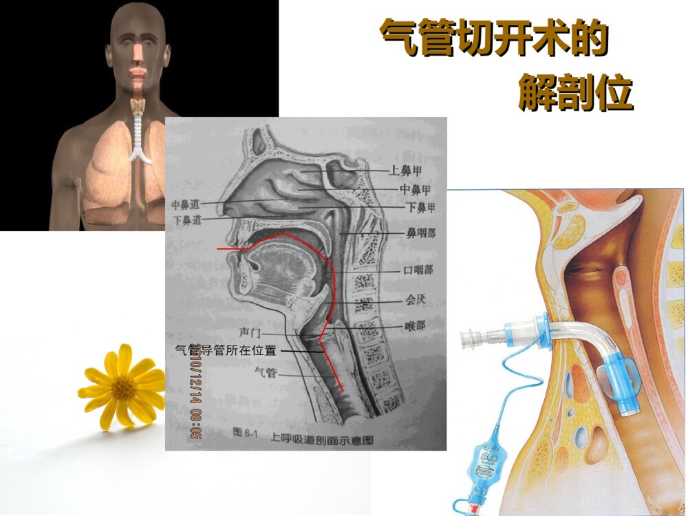 气管切开患者伤口的护理ppt课件下载4