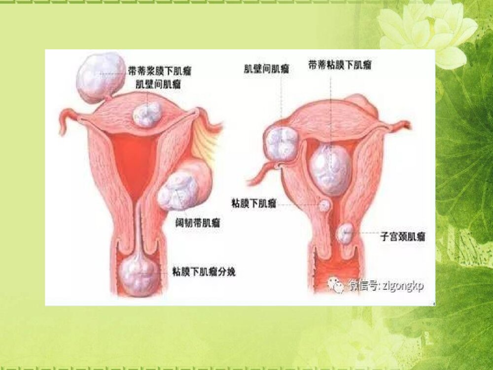 子宫肌瘤病人护理查房ppt课件下载5