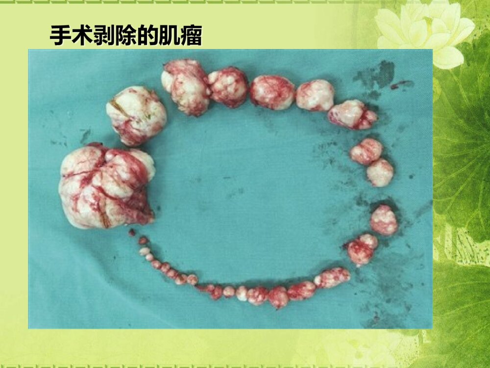 子宫肌瘤病人护理查房ppt课件下载6