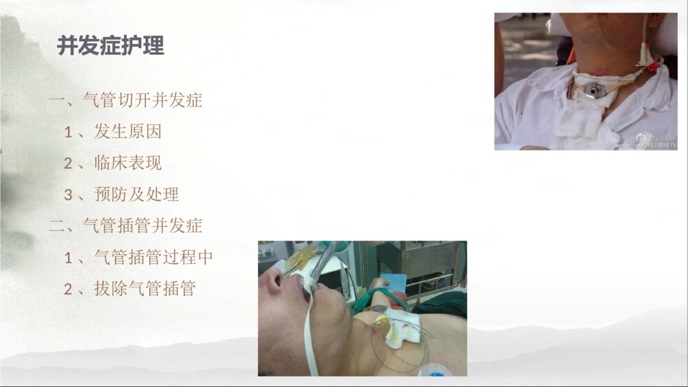 气管切开与气管插管护理ppt课件下载2