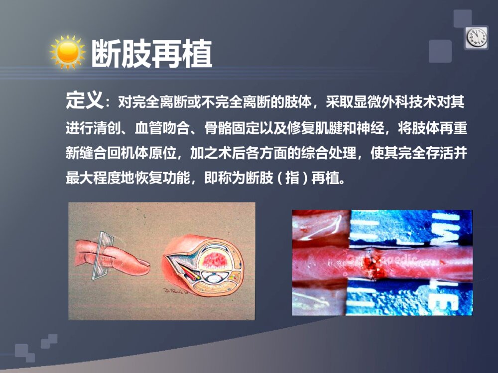 断肢再植护理个案ppt课件下载3