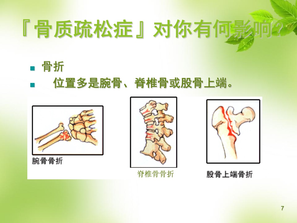骨质疏松的科普ppt课件7