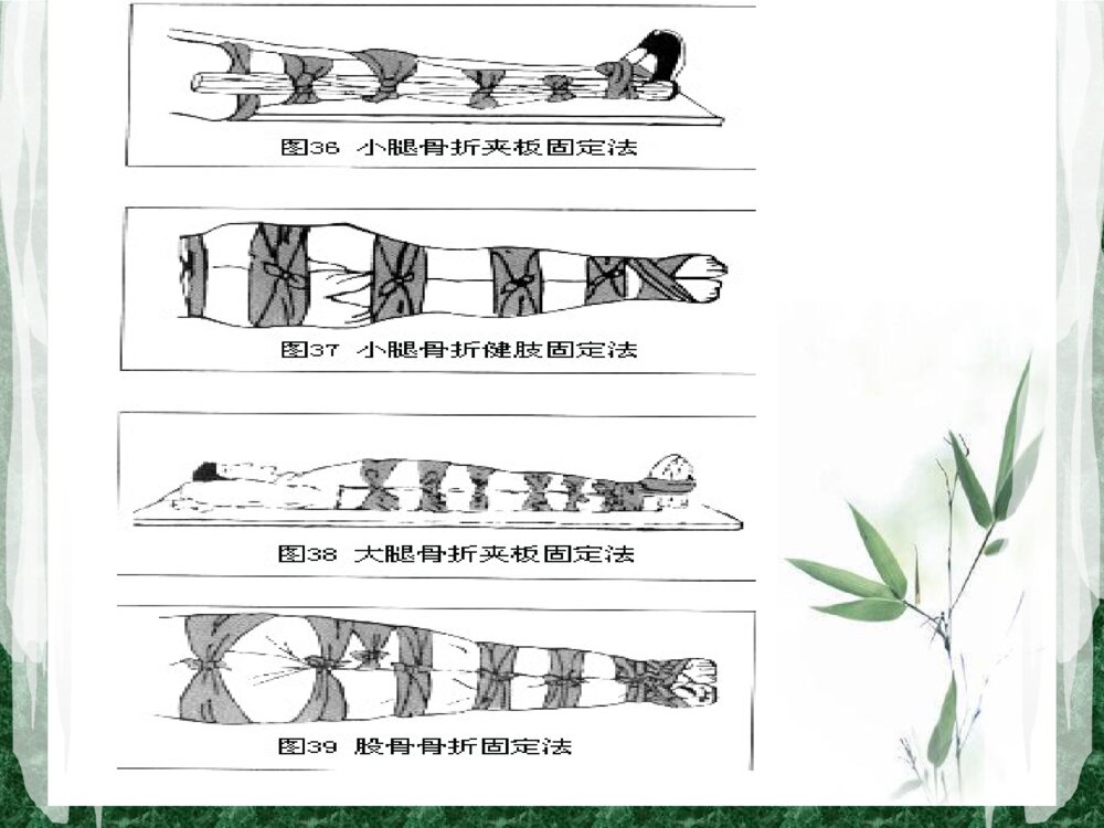 骨科骨折病人的搬运ppt课件8