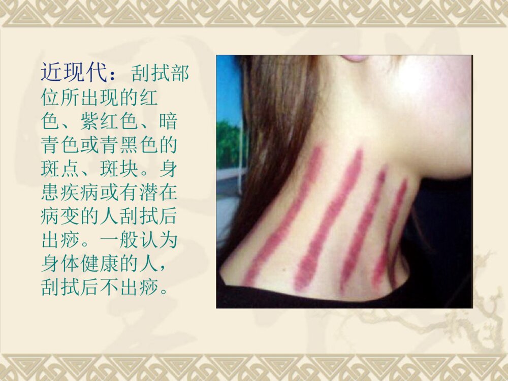 刮痧和拔罐备课4+3讲ppt课件3