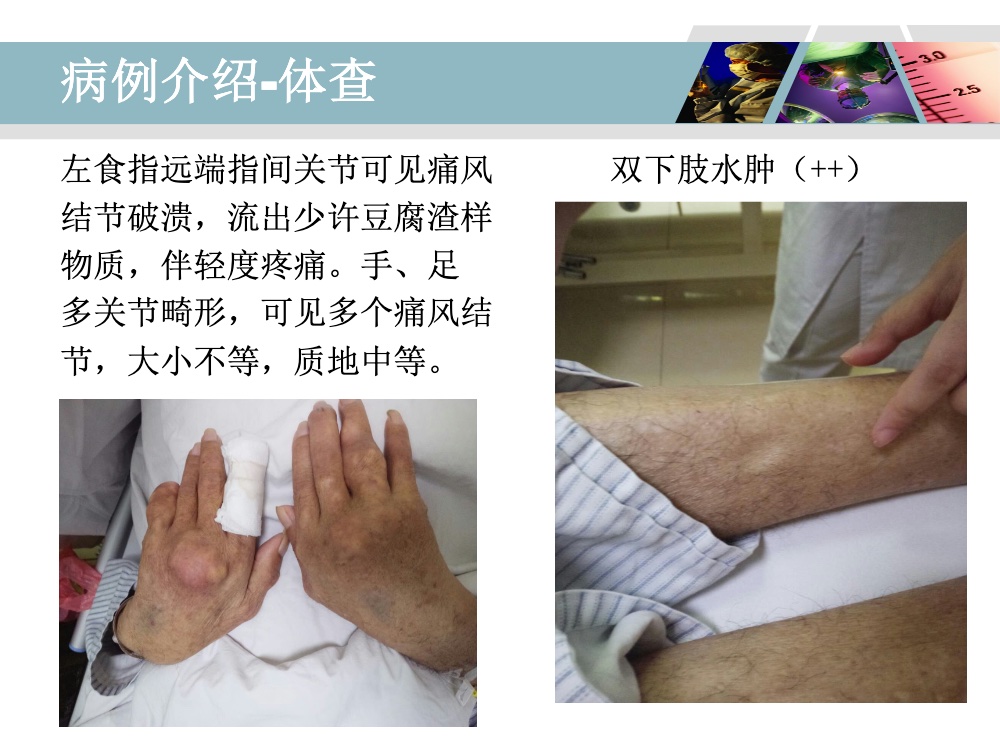 高血压肾病合并痛风性关节炎的个案护理ppt课件7