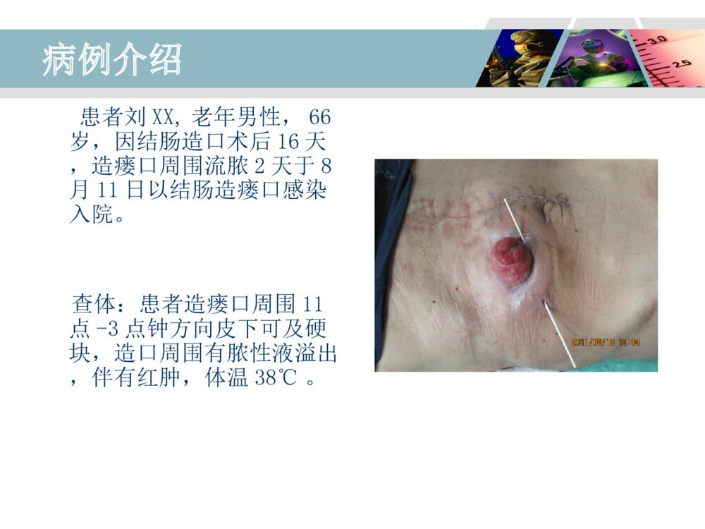 降结肠造口术后造口周围脓肿病人的护理ppt课件3