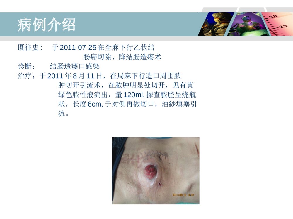 降结肠造口术后造口周围脓肿病人的护理ppt课件4