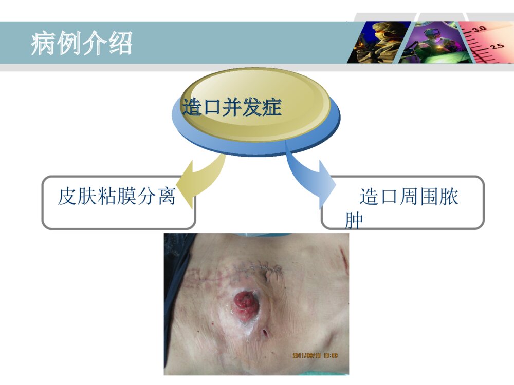 降结肠造口术后造口周围脓肿病人的护理ppt课件6