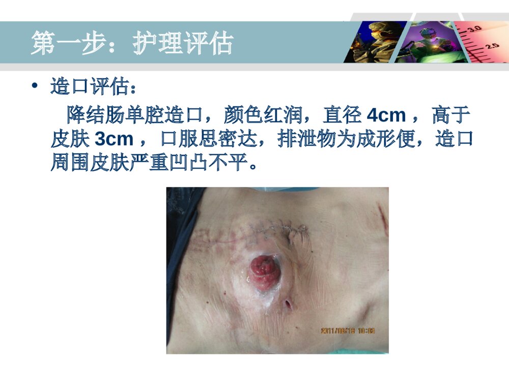 降结肠造口术后造口周围脓肿病人的护理ppt课件8