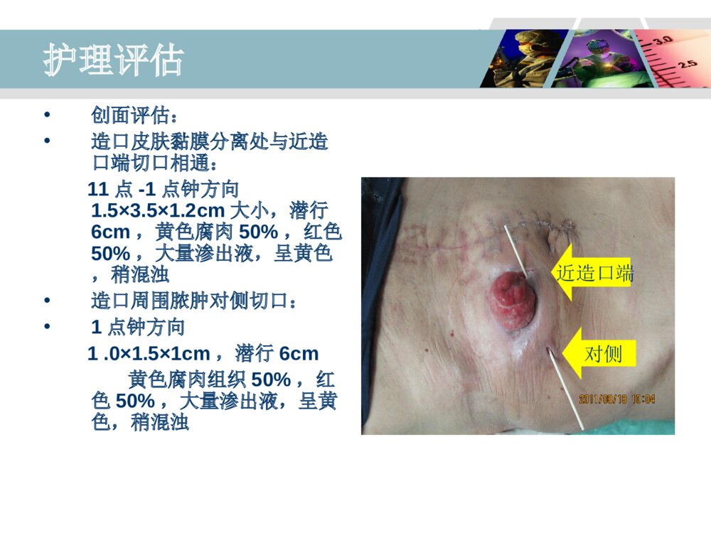 降结肠造口术后造口周围脓肿病人的护理ppt课件9