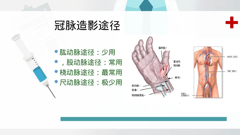 冠脉介入治疗及护理ppt6