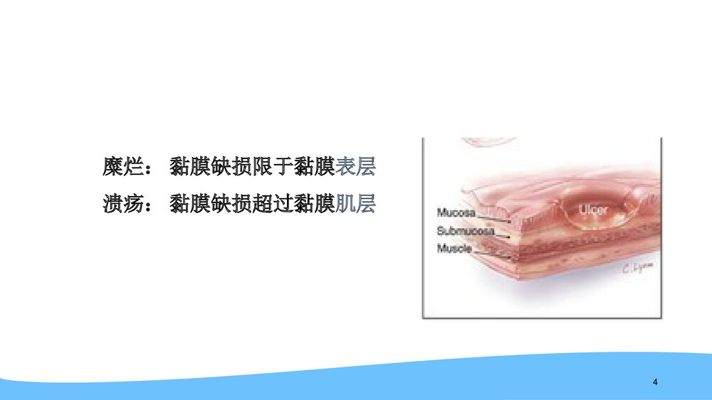(消化内科)消化性溃疡用药及护理PPT课件4