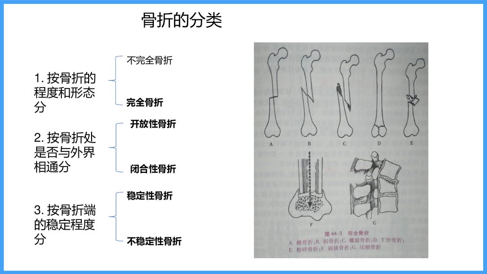 下肢骨折病人的护理PPT课件4