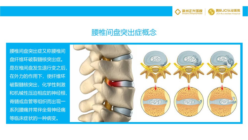 腰椎间盘突出症诊断与治疗PPT课件8