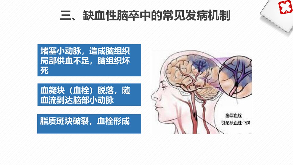 急性缺血性脑卒中静脉溶栓治疗及护理PPT课件7