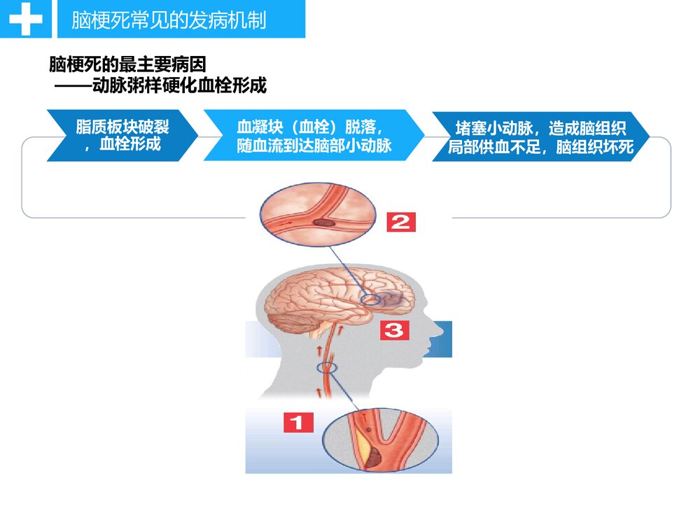 急性脑卒中静脉溶栓病人的护理PPT课件ppt10