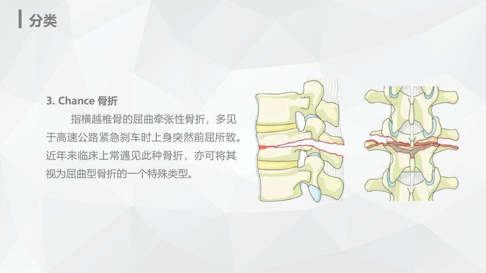 腰椎骨折的护理业务知识PPT课件8