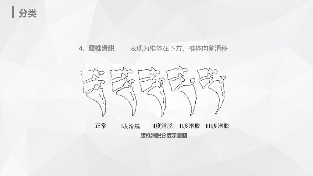 腰椎骨折的护理业务知识PPT课件9
