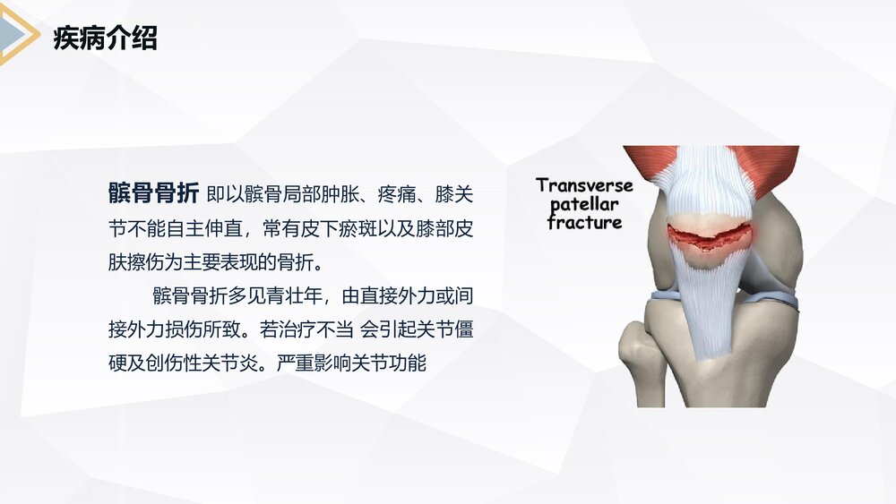 髌骨骨折的护理查房PPT课件6