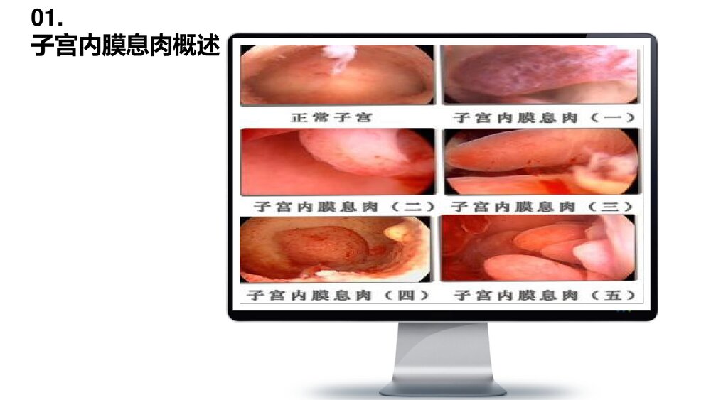 (妇科)子宫内膜息肉检查治疗护理PPT课件4