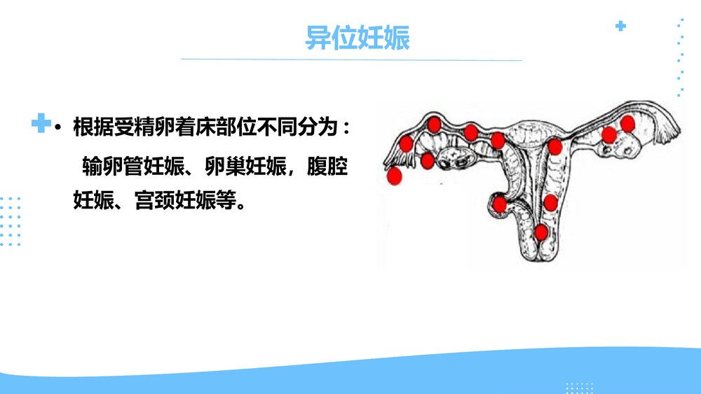 异位妊娠临床表现护理评估及护理措施PPT课件5