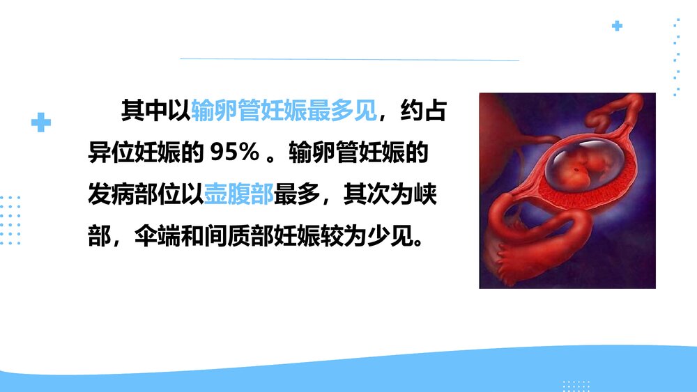 异位妊娠临床表现护理评估及护理措施PPT课件6